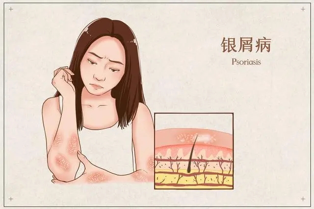人为什么会得牛皮癣呢