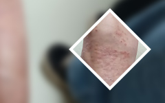 避免牛皮癣的加重你是怎么做的